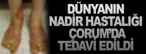 Dünyada nadir hastalığı Çorum'da tedavi edildi