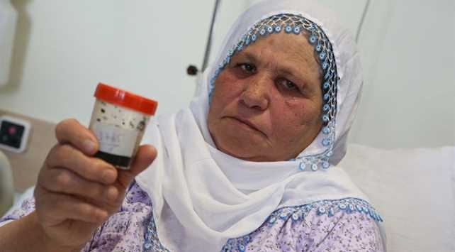 Doktor gözlerine inanamadı safra kesesinden 3 bin 765 taş çıktı