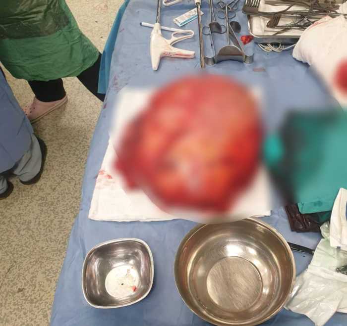 Uyluk kemiğinden 8,9 Kiloluk Tümör Çıktı